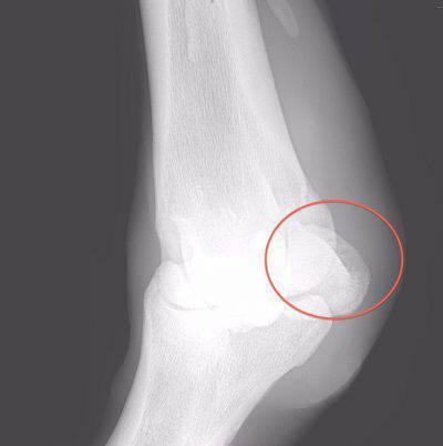 frattura-sesamoide