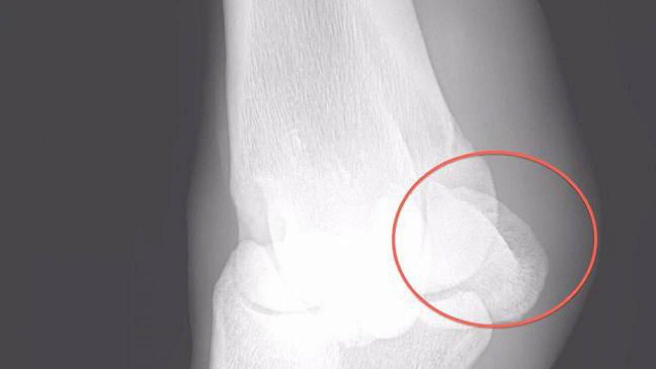 Cavallo Trottatore Frattura E Chirurgia Delle Ossa Sesamoidee