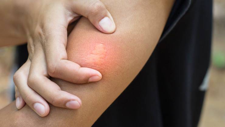 puntura di insetto sul braccio